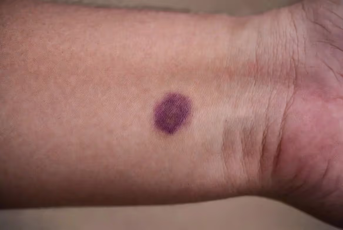 Typical paintball bruise example